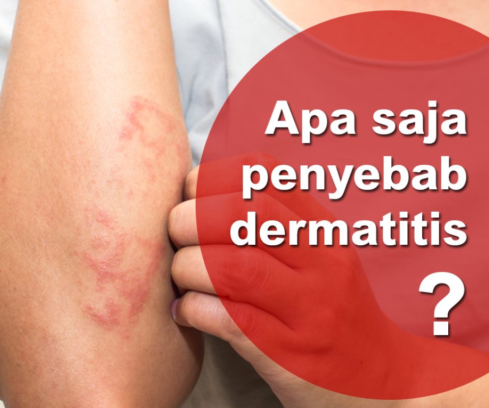 Penyebab Dermatitis
